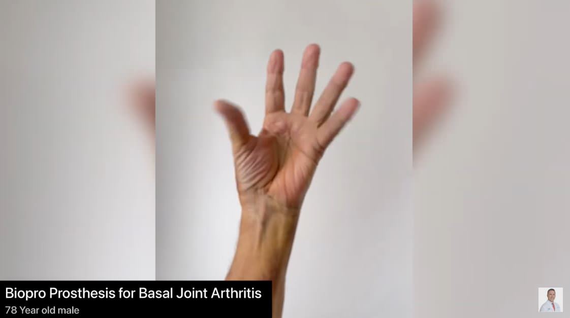 BioPro Prosthesis for Basal Joint Arthritis