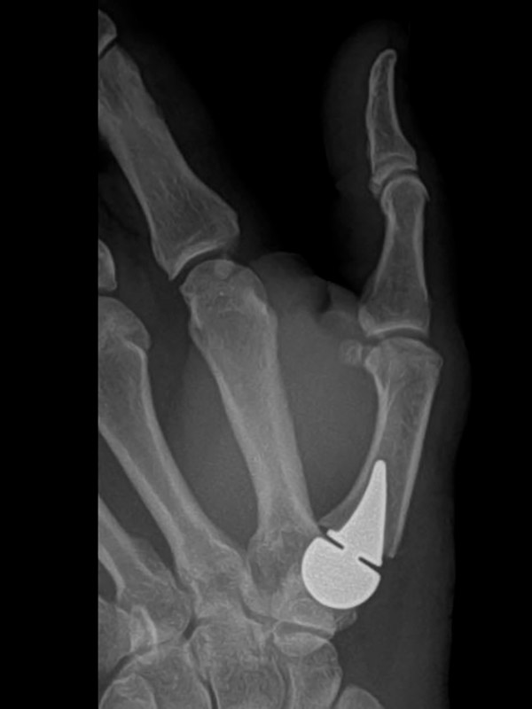 BioPro implant on X-ray